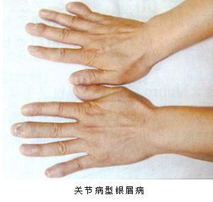 关节型银屑病的病因是什么？