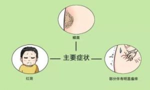 红皮病型银屑病的简介和病因